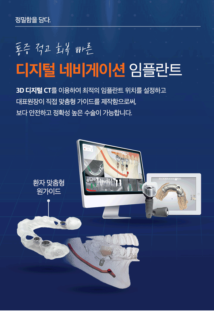 디지털 네비게이션 임플란트